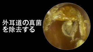 Remove Fungus From Gentleman's Ear Canal