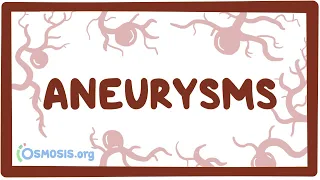 Aneurysms - causes, symptoms, diagnosis, treatment, pathology