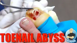 RELEASING A POCKET OF INFECTION IN A TOENAIL