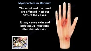 Mycobacterium Marinum - Everything You Need To Know - Dr. Nabil Ebraheim