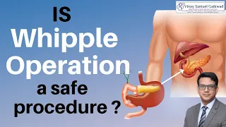 Is Whipple operation a safe Procedure | Whipple Procedure To Beat Cancer | Dr. Vinay Samuel Gaikwad