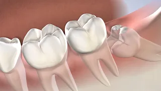 Wisdom Teeth Removal at Oral Surgery & Dental Implant Specialists of Cincinnati
