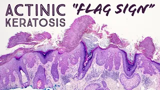 Hypertrophic Actinic Keratosis with perfect "flag sign" (dermatology pathology dermatopathology)