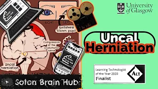 Uncal Herniation