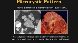 CT Evaluation of Cystic Pancreatic Masses: A Systemic Approach Part 1