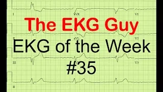 EKG/ECG of the Week #35 | The EKG Guy - www.ekg.md