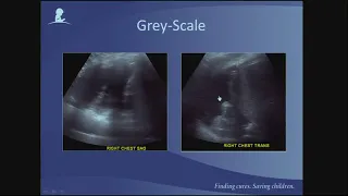 Ultrasound in  Focal Liver Lesions and Beyond