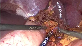 Лапароскопическая дистальная энуклеация инсулиномы / Laparascopic distal enucleation of insulinoma