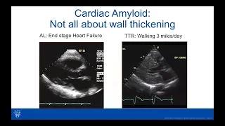 Cardiac Amyloidosis Webinar