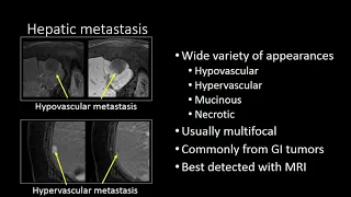 GI Imaging - Hepatic Metastasis