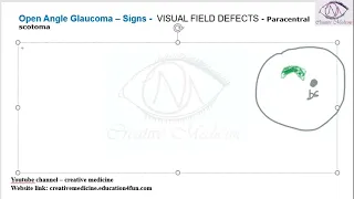 Lec 7 Open Angle Glaucoma – Signs    VISUAL FIELD DEFECTS   Paracentral scotoma mp4 || OPHTHALMOLOGY
