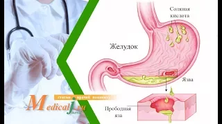 Прободная язва. Каковы причины? Какие симптомы? Как лечить?