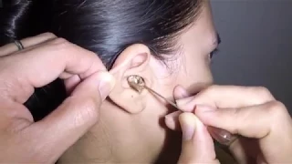 Woman's Earwax Finally Removed after 25 Years