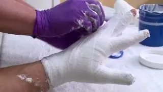 Changing a hand wrapping bandage after a burn injury