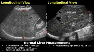 How To Measure Liver On Ultrasound | Craniocaudal Length, Transverse, Volume & AP Measurements USG