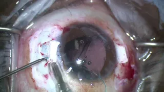 Globe Rupture, Lensectomy, Intrascleral Fixated Intraocular Lens