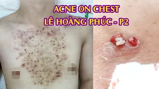 Removing Acne On Chest For You Male | Điều trị mụn ngực Lê Hoàng Phúc |  Part 2 | 520