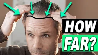 How Far Can You Move Your Hairline With Hair Transplant?