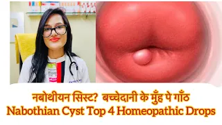 नबोथीयन सिस्ट? बच्चेदानी के मुँह की गाँठ? Nabothian Best Homeopathic Medicine? cervical Bumps Drops