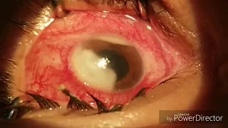 Fungal keratitis intrastromal antifungal therapy 2