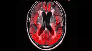 The Aging Brain: Week by Week Time Lapse