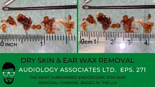 12 DAYS OF WAXMAS - EAR WAX REMOVAL DAY 5 - EP 271