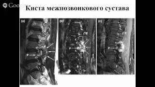 «Боль в спине - эволюция парадигмы»