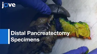 Distal Pancreatectomy Specimens: DIPLOMA Approach