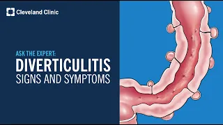 Warning Signs of Diverticulitis | Ask Cleveland Clinic's Expert