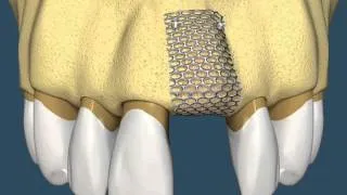 Implantes Dentários -  Com Enxerto Ósseo