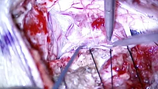 Left far lateral approach for resection of ventral foramen magnum meningioma