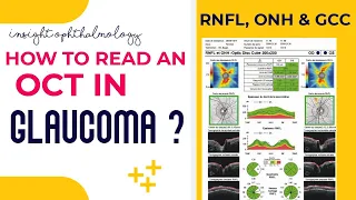 HOW TO READ AN OCT PRINTOUT IN GLAUCOMA || STEPWISE || EXTREMELY EASY || PART -2