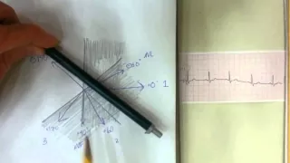 Simple Mean Electrical Axis Tracing on EKG Strip