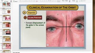 Clinical exam of the Orbit