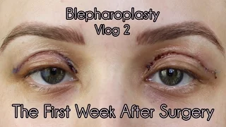 My Eyelid Surgery 1st Weeks of Recovery | Cosmetic Blepharoplasty Diary Part 2