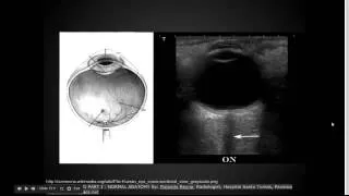 Ocular ultrasound:  "EM in 5"