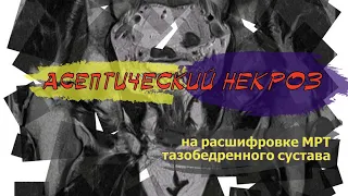 АСЕПТИЧЕСКИЙ НЕКРОЗ головки бедренной кости на РАСШИФРОВКЕ МРТ тазобедренных суставов (2 мнение)