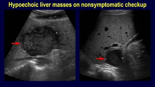 Hypervascular liver masses of different imaging patterns in a patient of brain tumor