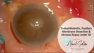 Endophthalmitis +Pupillary Membrane Dissection