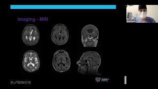 Grand Rounds- Contemporary Management of the Colloid Cyst- Dr. David Harter, Neurosurgeon, NYU