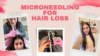 I Tried Microneedling For My Hair Loss