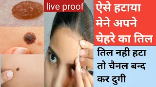 चेहरे से तिल और मस्से हटाये सिर्फ 10 मीनेट मे This is how you can remove moles warts and skin Tags