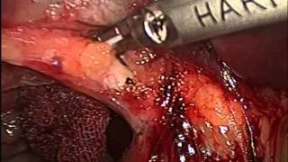 Laparoscopic treatment of Hydatid Cyst