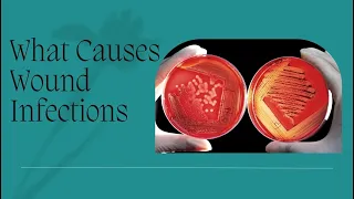 The Truth About Wound Infections: What Causes Them