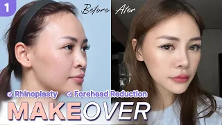 [SUB] For a smaller and enhanced look, join her journey getting Forehead Reduction and Rhinoplasty!