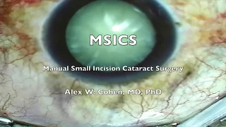 Manual small incision cataract surgery (MSICS)