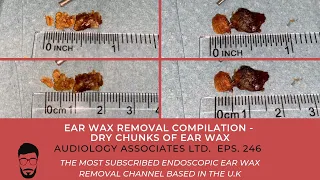 EAR WAX REMOVAL COMPILATION - DRY CHUNKS OF EAR WAX - EP 246