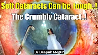 Soft Cataract Can be  tough..? The Crumbly Cataract - Dr Deepak Megur