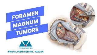Surgery for ventrally placed foramen magnum tumors-Dr.M.J.Arunkumar-Hannah Joseph Hospital, Madurai