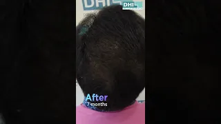 Full scalp coverage with maximum density  | DHI Hair Implantation